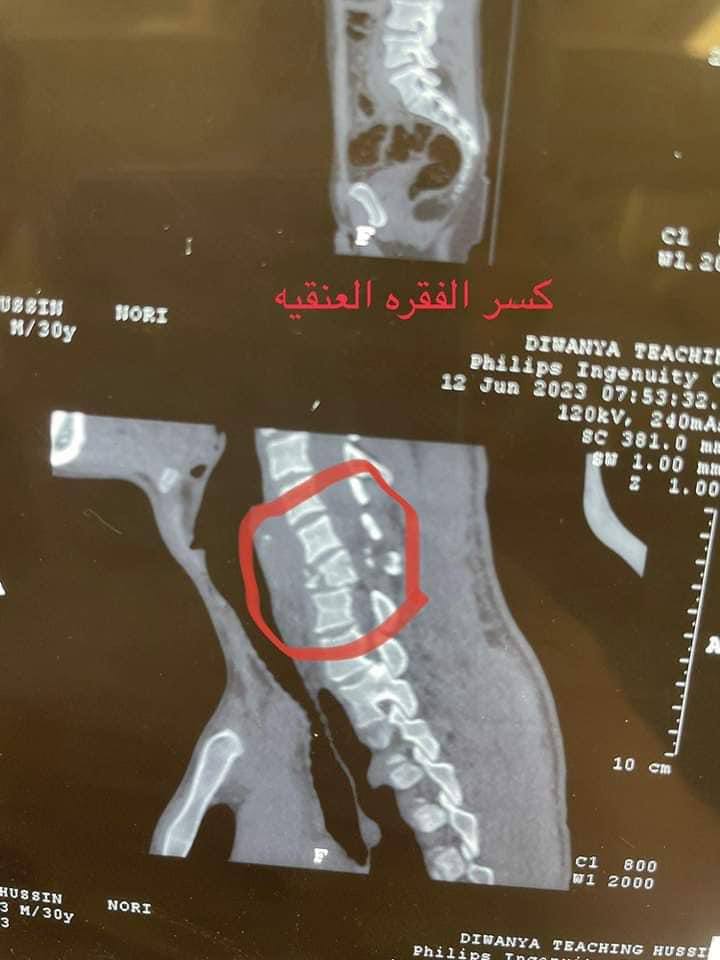 الفقرة العنقية